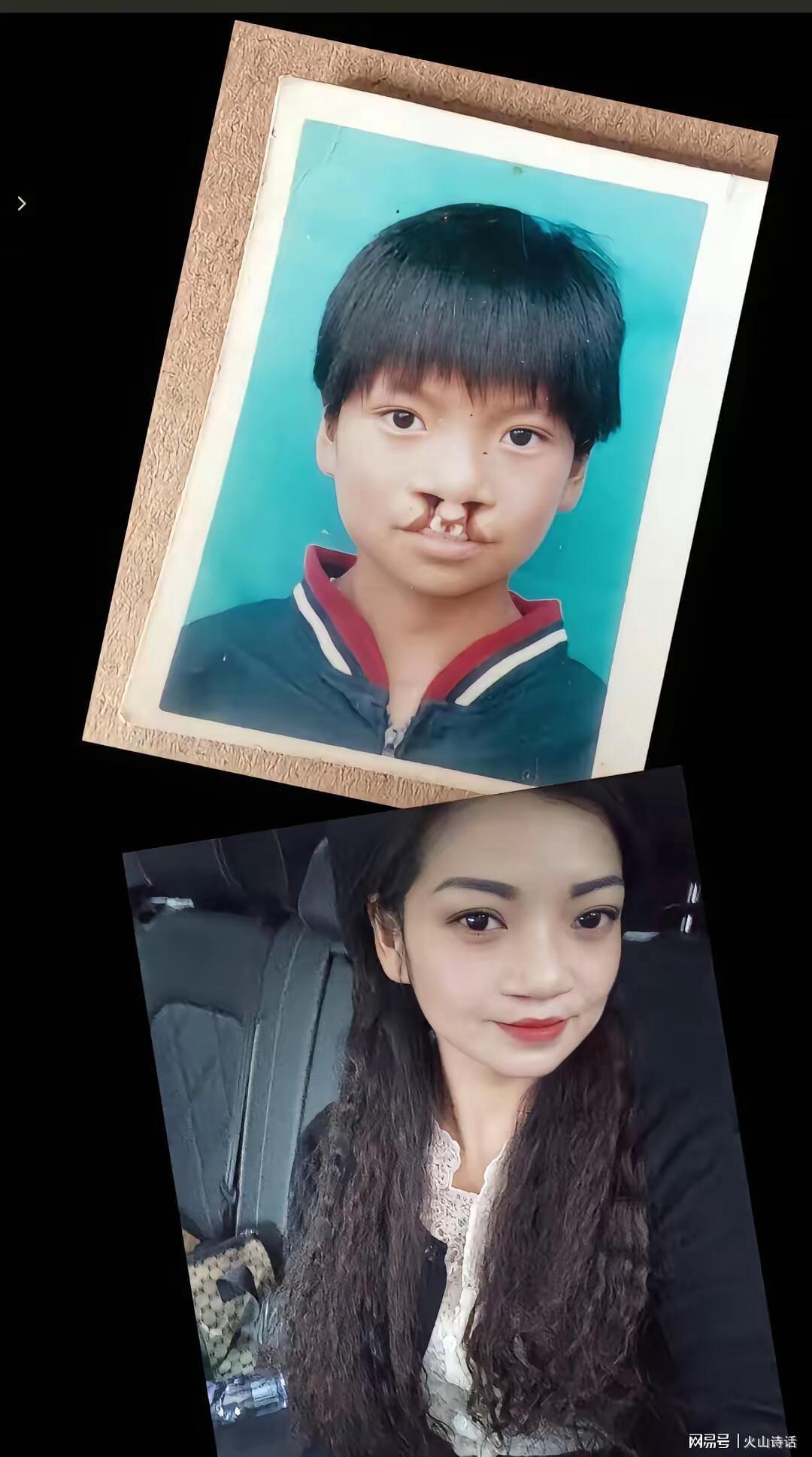 篮球比分-震惊！为声援李亚鹏，一漂亮女孩坦然展示自己唇腭裂手术前后照片